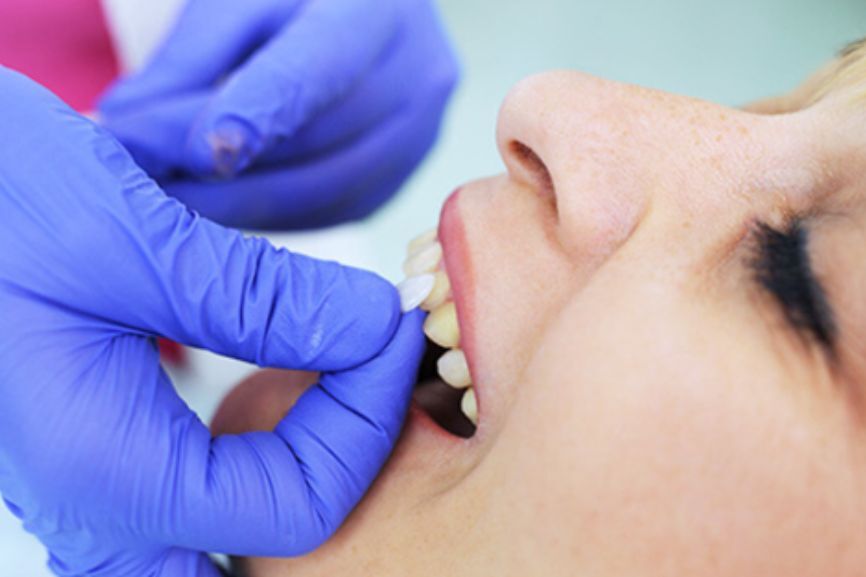 Featured image for “How Long Do Veneers Last? A Comprehensive Guide”